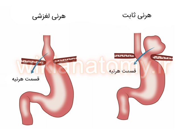 هرنی هیاتال